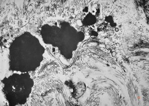 M,66y. | follicular cyst with hyaline Rushton bodies